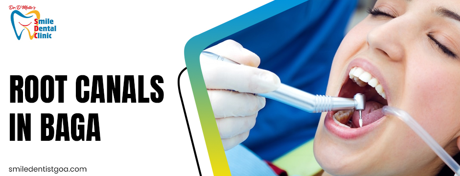 Root canals in Baga